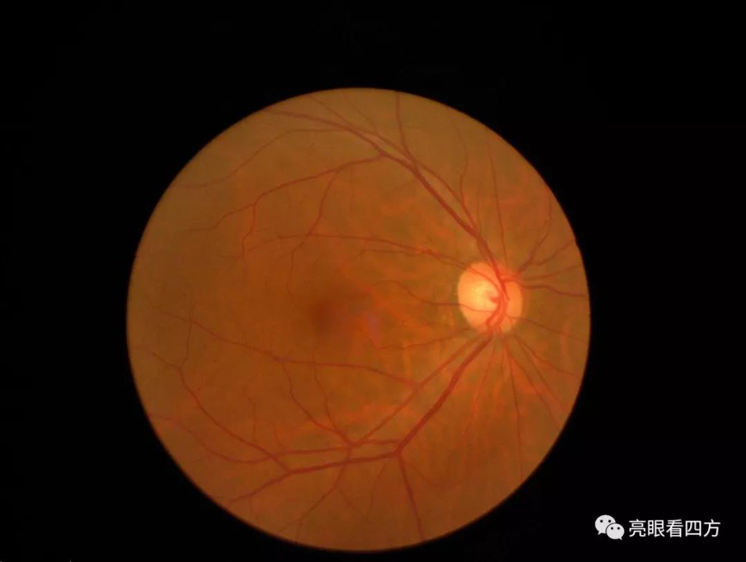三种常见眼底病:黄斑水肿，黄斑裂孔，黄斑新生血管，病变oct检查图示说明 - 知乎